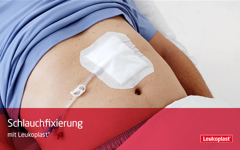 In diesem Video demonstrieren wir die Befestigung eines Schlauchs auf dem Bauch, mit Hilfe des selbstklebenden Rollenpflasters: Das Fachpersonal fixiert dazu den Schlauch mit dem Leukoplast Pflaster. In diesem Video demonstrieren wir die Befestigung eines Schlauchs auf dem Bauch, mit Hilfe des selbstklebenden Rollenpflasters: Das Fachpersonal fixiert dazu den Schlauch mit dem Leukoplast Pflaster.